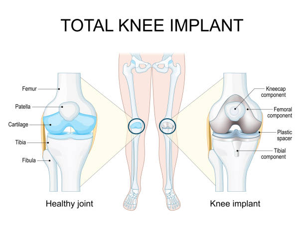 Best Total Knee Replacement Surgeon In Mulund-1